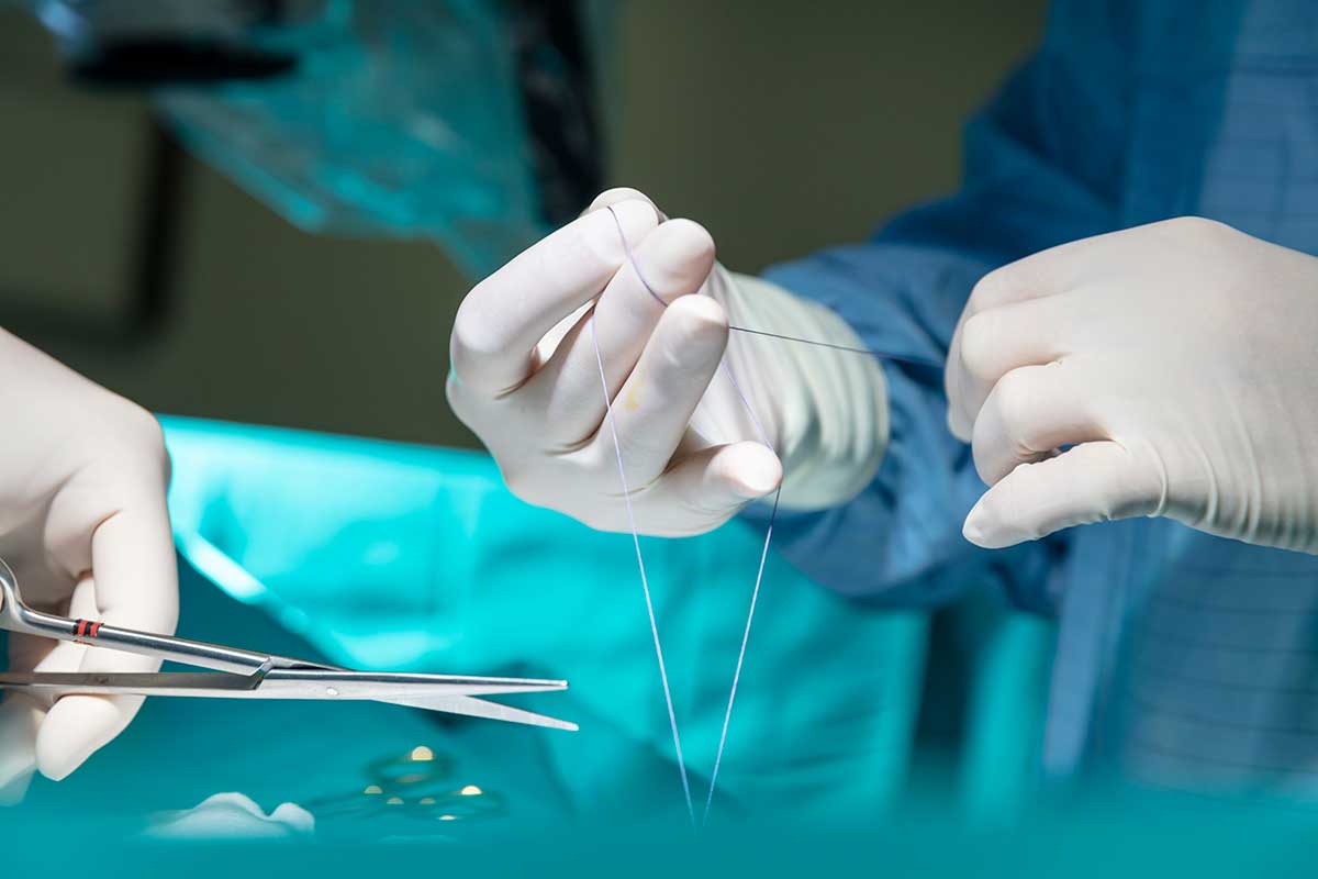 Stitches vs Sutures: A Guide